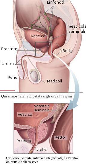 prostata ingrossata