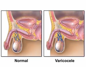 gonfiore lì sotto Varicocele