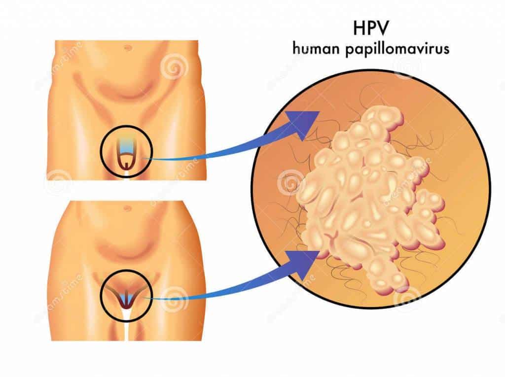 hpv papilloma virus