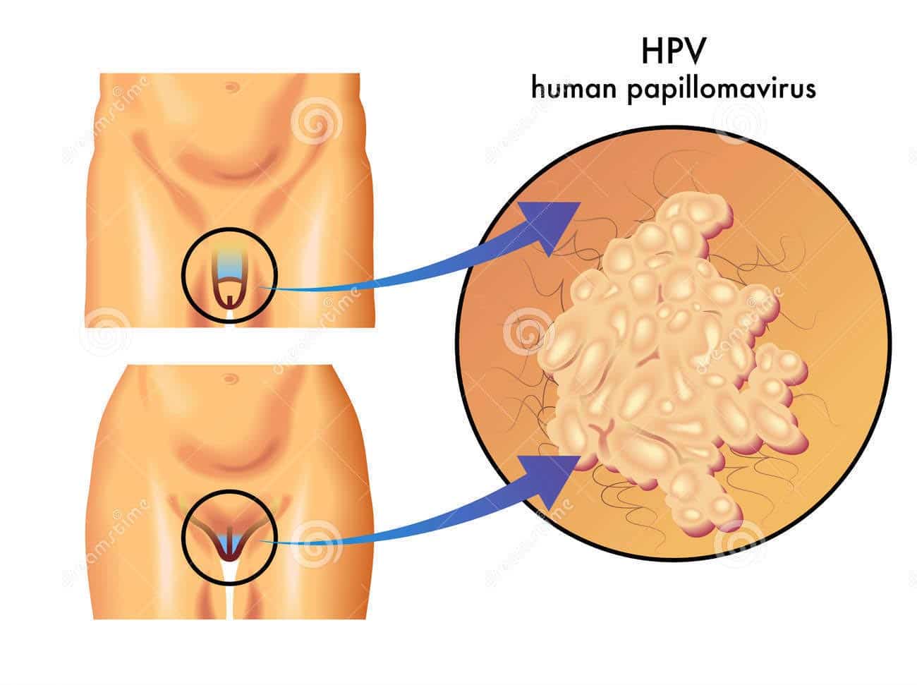 papilloma virus nel uomo dermatita de contact