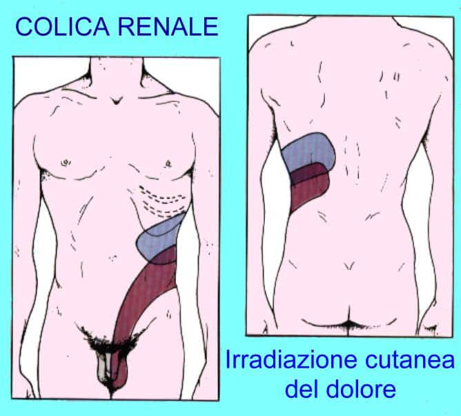 coliche renali