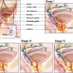 Cancro alla prostata: la paura, la fuga, la reazione. Da uomo a uomo 1 CANCRO ALLA PROSTATA