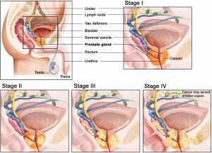 CANCRO ALLA PROSTATA