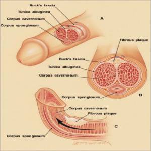 induratio penis