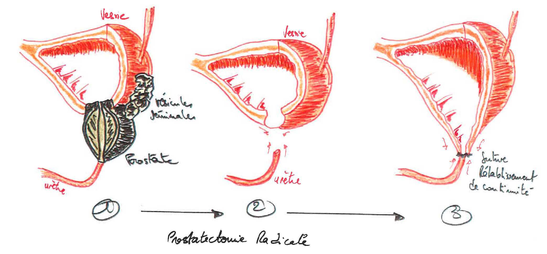 Prostatectomia radicale e incontinenza