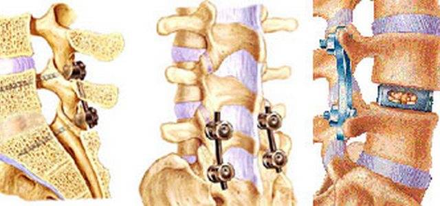 Stabilizzazione vertebro-sacrale, operazione riuscita al Versilia