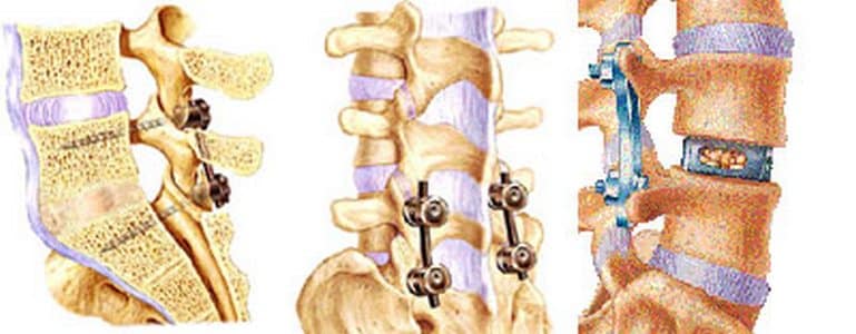 stabilizzazione vertebro-sacrale
